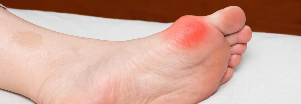 Hallux valgus schoenen