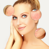 Natuurlijke oplossingen bij acne rosacea